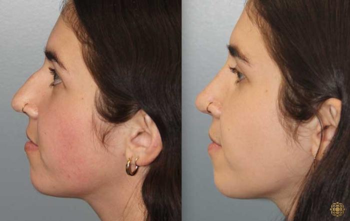 Before & After Rhinoplasty Case 174 Left Side View in Newport Beach, CA