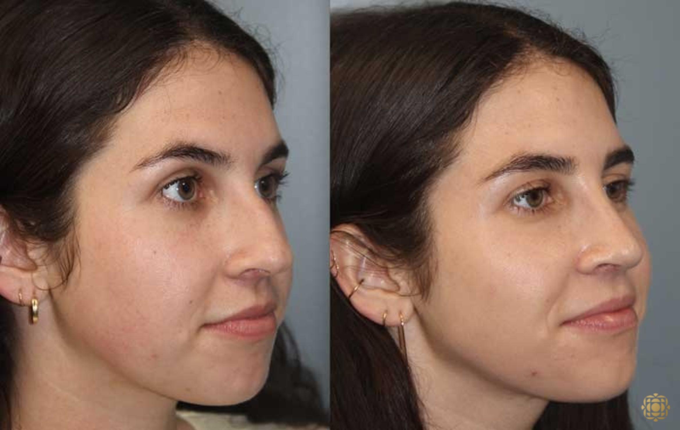 Before & After Rhinoplasty Case 174 Right Oblique View in Newport Beach, CA