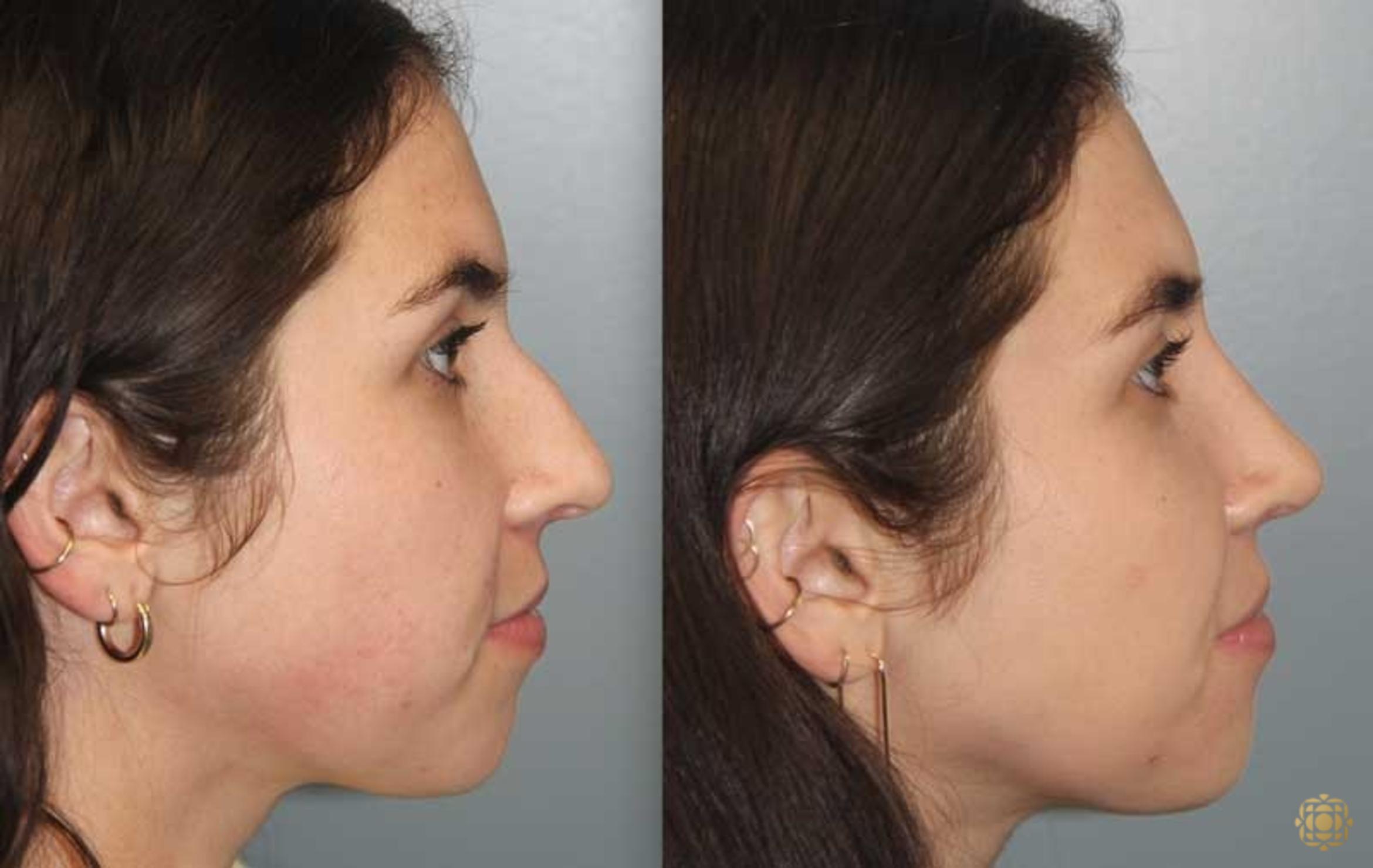 Before & After Rhinoplasty Case 174 Right Side View in Newport Beach, CA