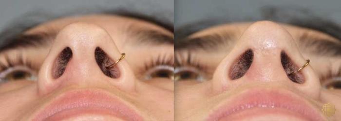 Before & After Rhinoplasty Case 174 Under View in Newport Beach, CA