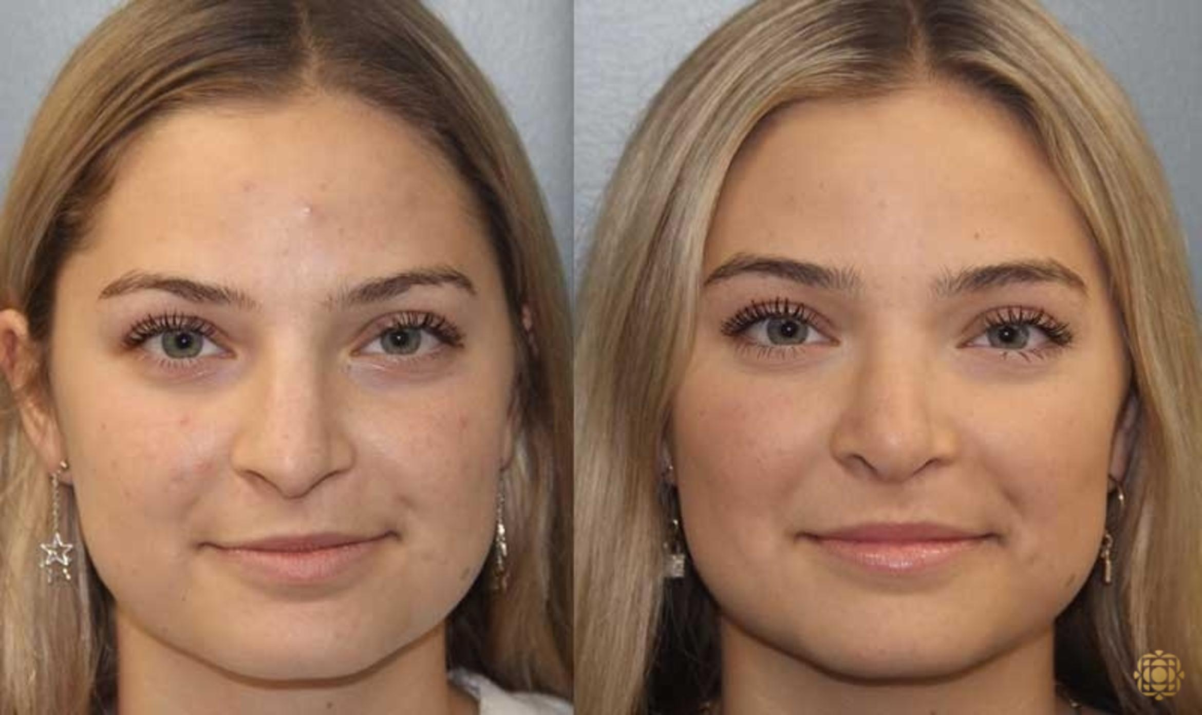 Before & After Rhinoplasty Case 180 Front View in Newport Beach, CA
