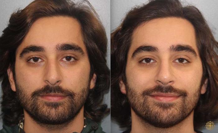 Before & After Rhinoplasty Case 191 Front View in Newport Beach, CA