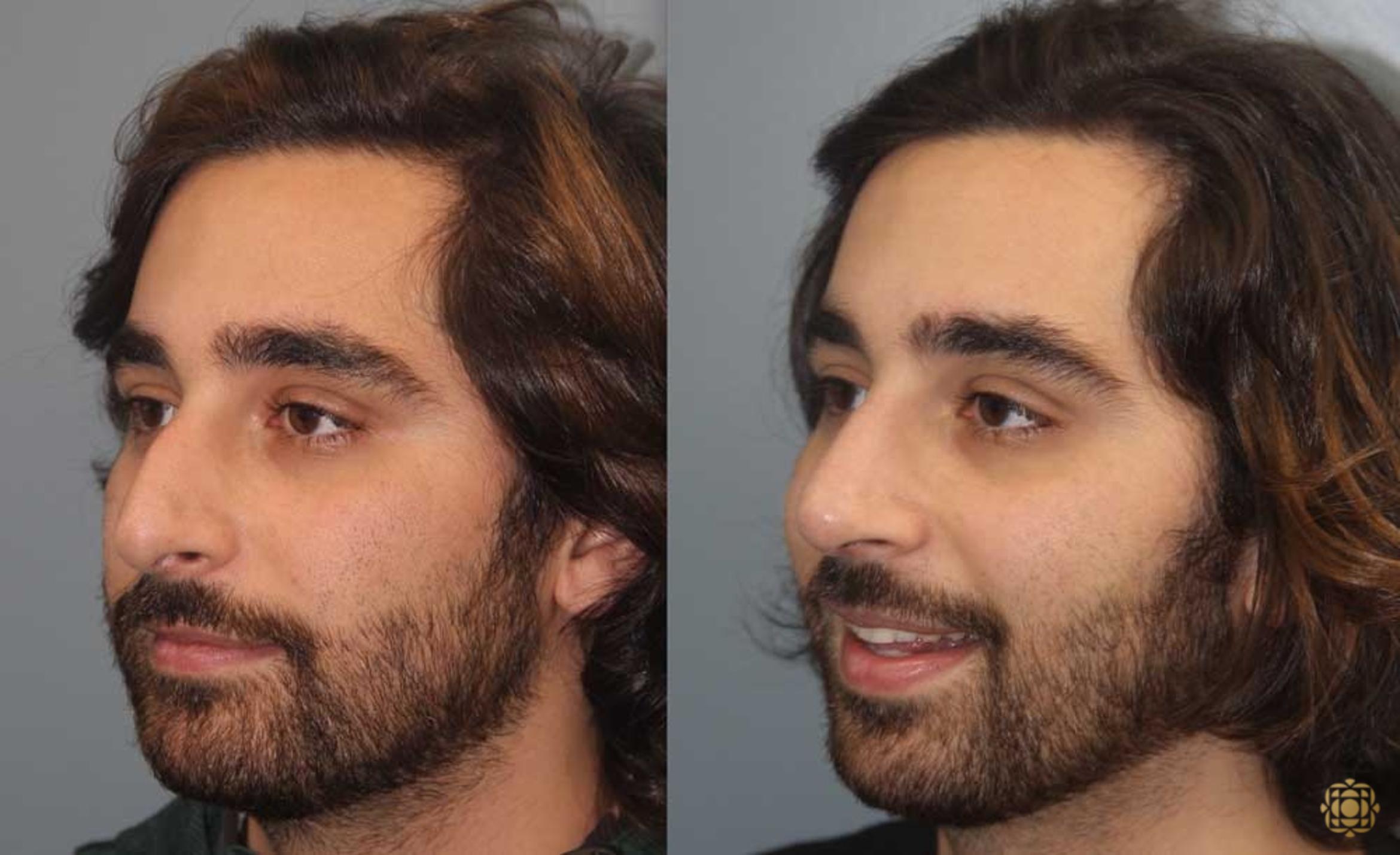 Before & After Rhinoplasty Case 191 Left Oblique View in Newport Beach, CA