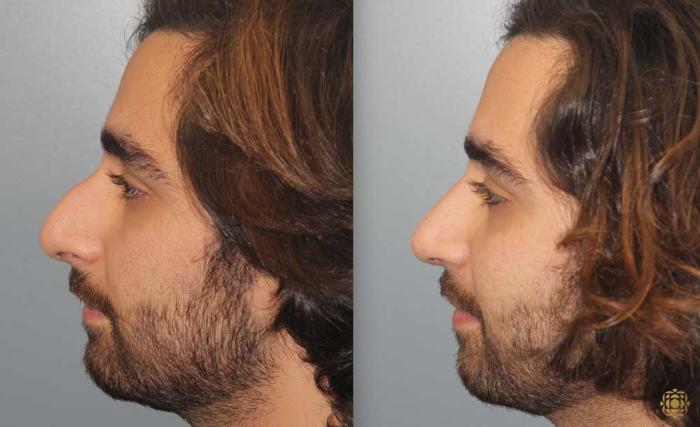 Before & After Rhinoplasty Case 191 Left Side View in Newport Beach, CA