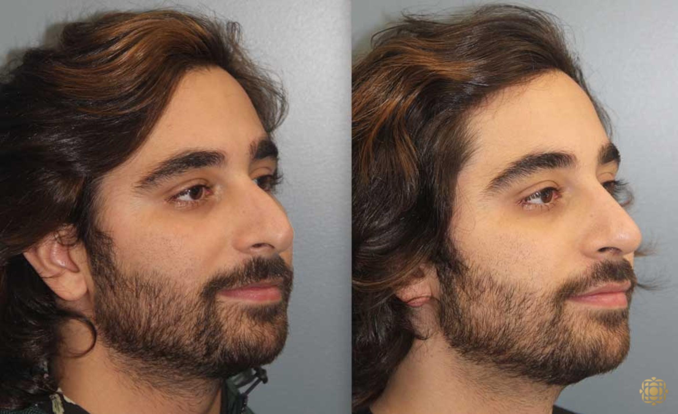 Before & After Rhinoplasty Case 191 Right Oblique View in Newport Beach, CA