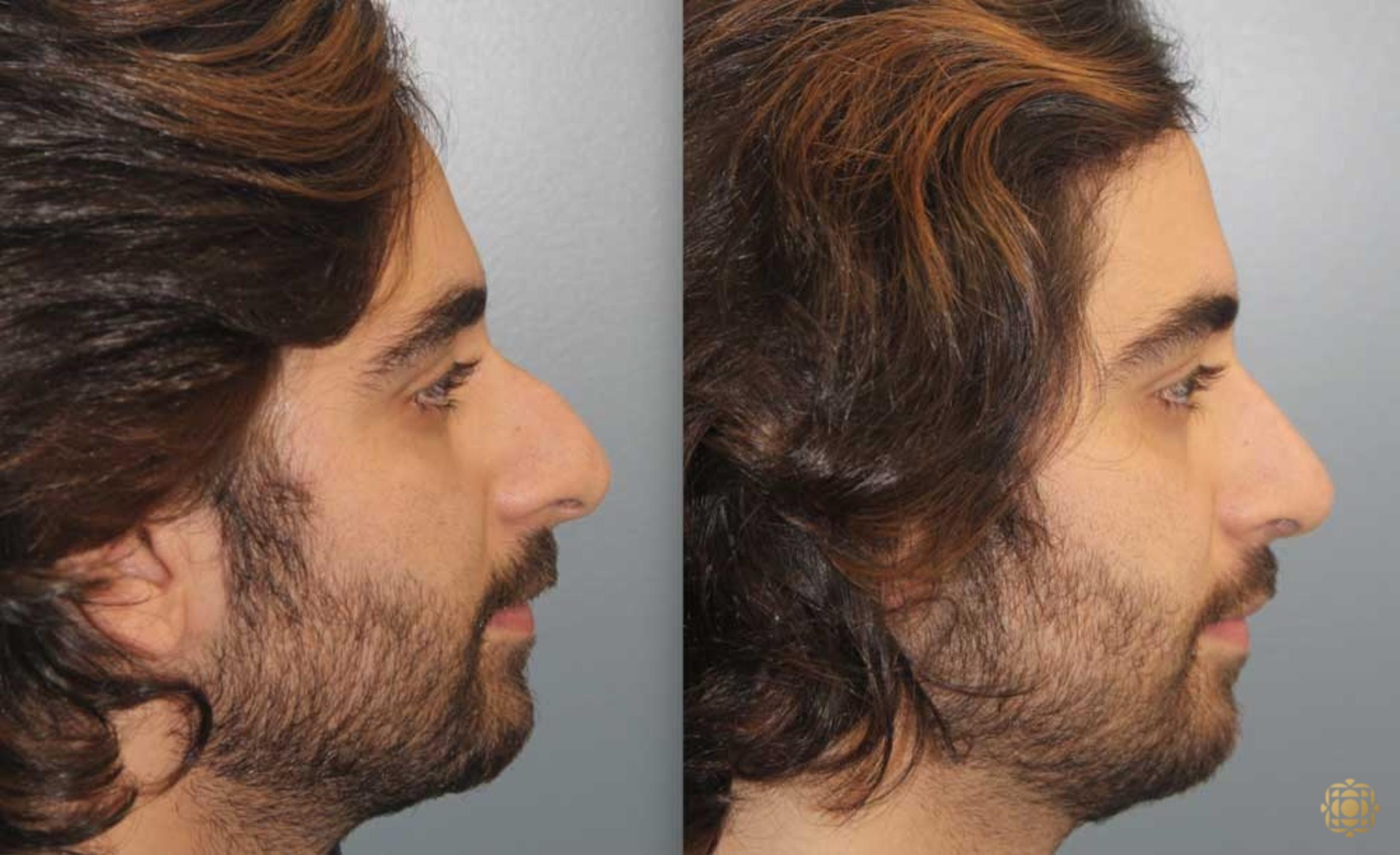 Before & After Rhinoplasty Case 191 Right Side View in Newport Beach, CA