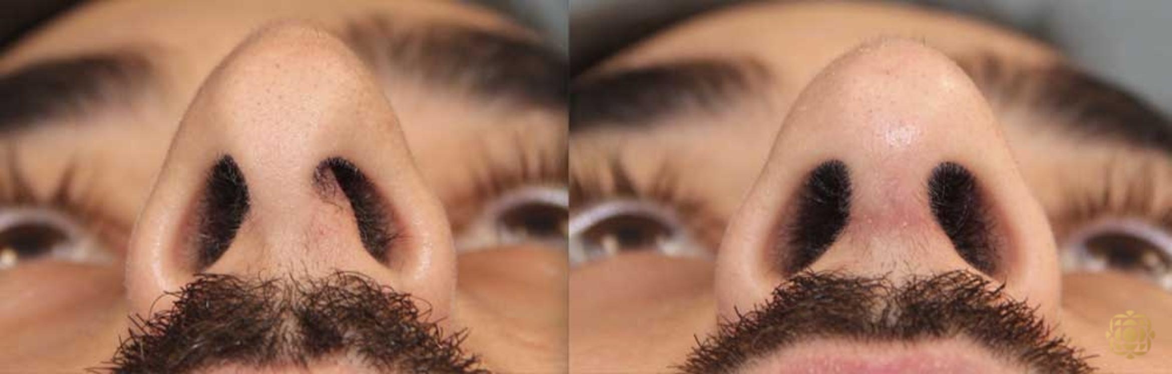 Before & After Rhinoplasty Case 191 Under View in Newport Beach, CA